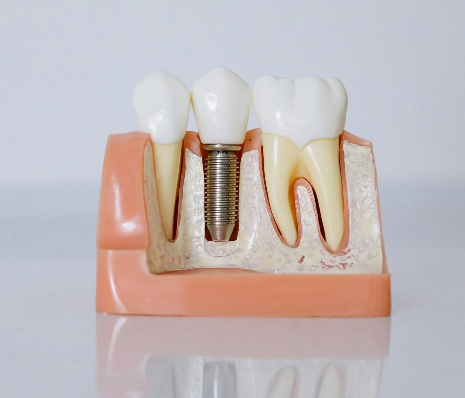 Detailed view of a dental implant model showcasing teeth and gum anatomy for dental education.