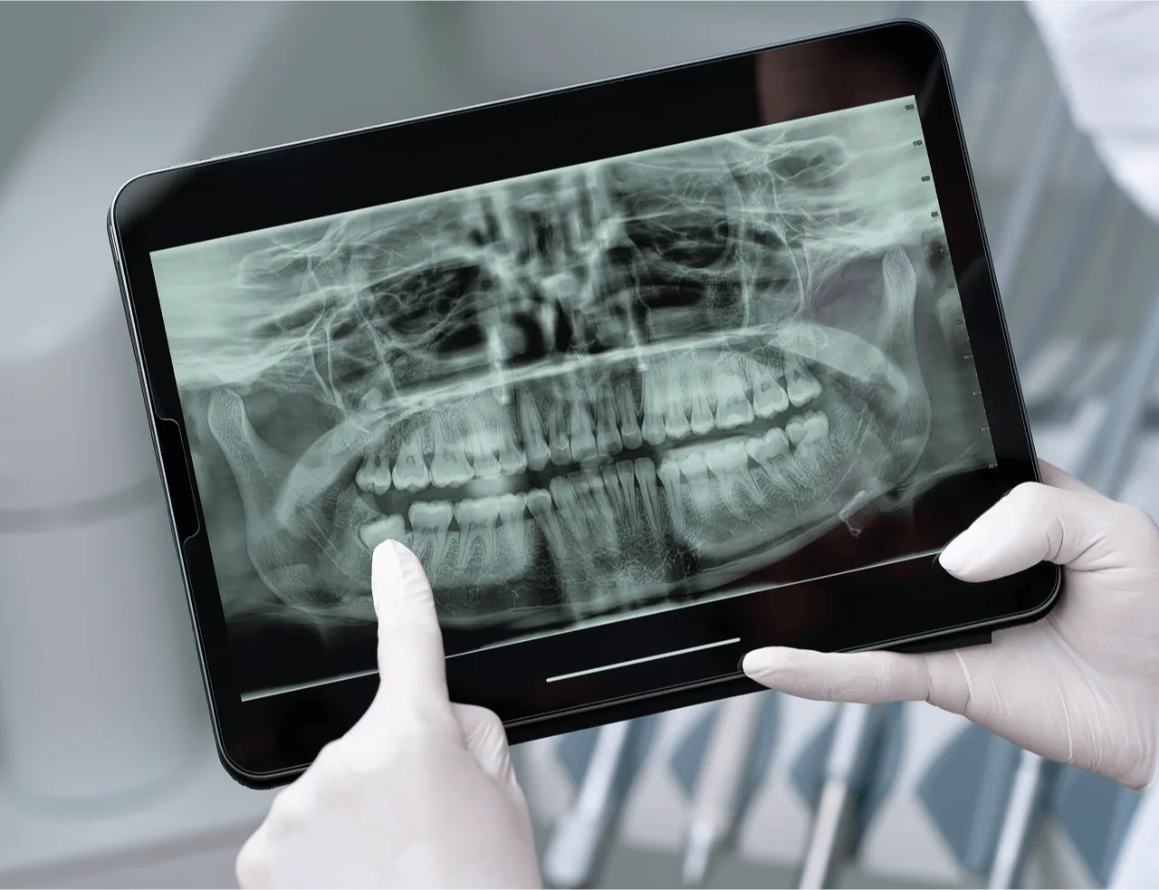 Digital dental X-ray displayed on a tablet.