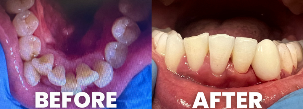 Clear Braces
