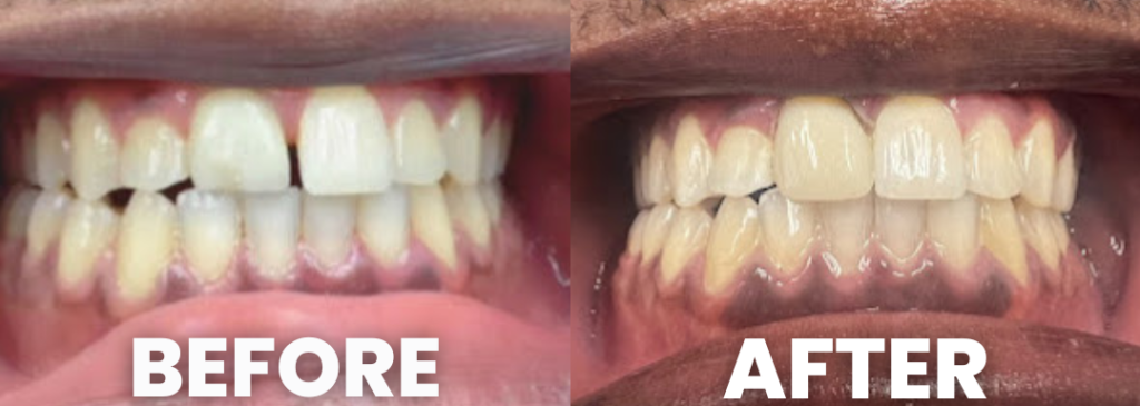Clear Braces