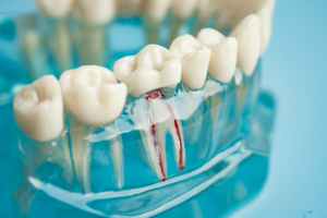 Root Canal in Boston, MA