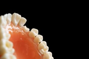 What to Do If You Break a Tooth: Emergency Care and Treatment Options for Tooth Fracture